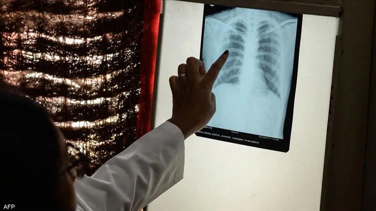 9 أعراض قد تكون من العلامات المبكرة لسرطان الرئة