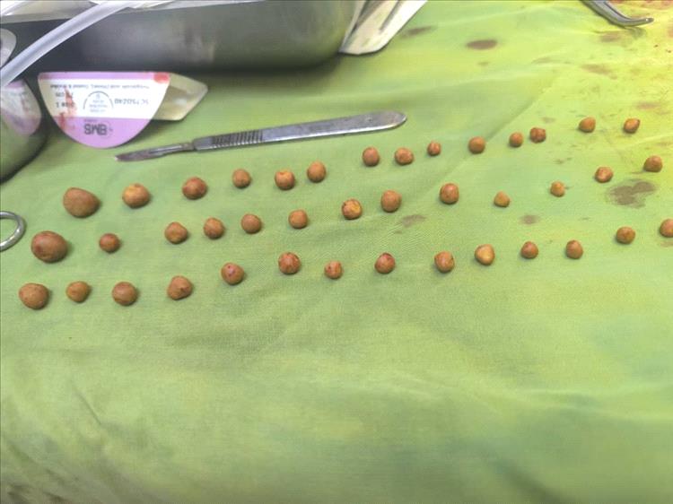 استخراج 41 حصوة لمريض في المستشفى الأردني بمحافظة عدن 