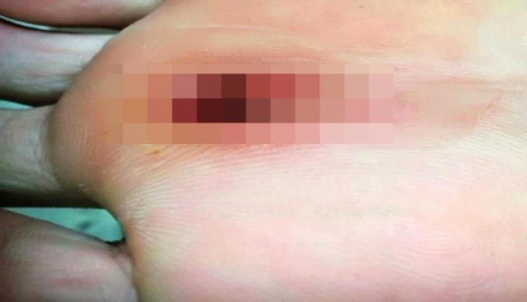 طبيب يكشف تشخيص حالة كزاز لشاب في صنعاء ويحذّر من التهاون في علاج الجروح