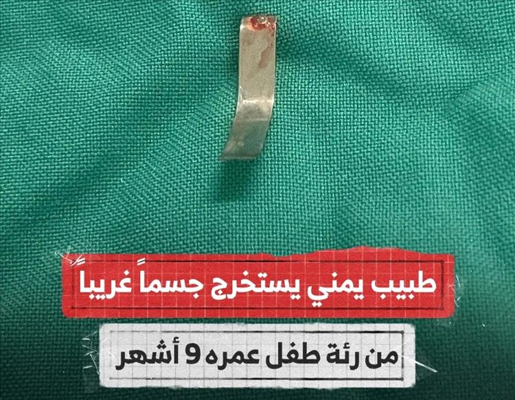 معجزة طبية في اليمن: استخراج جسم غريب من رئة طفل عمره 9 أشهر!