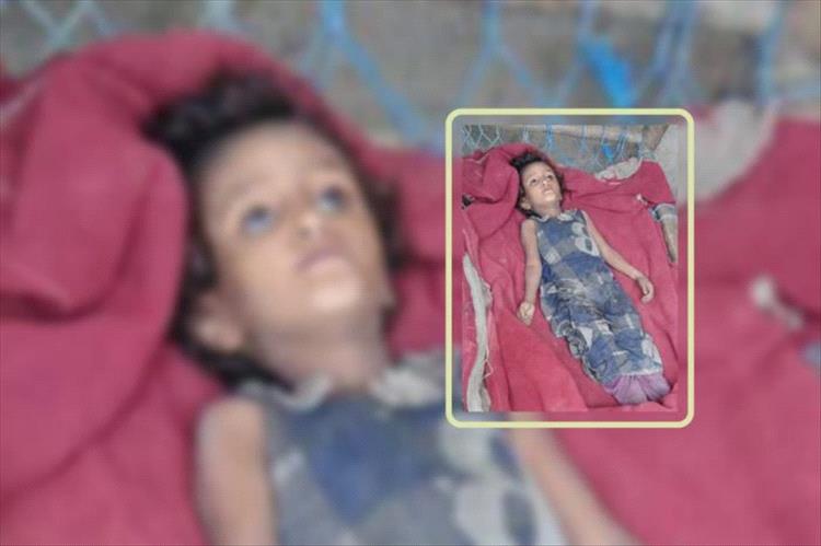 لحج.. الجوع يفتك بطفلة نازحة في ظل نهب الحوثيين للمساعدات