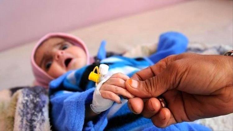 توم فليتشر: سوء التغذية طال نحو نصف أطفال اليمن جراء الأزمة الإنسانية