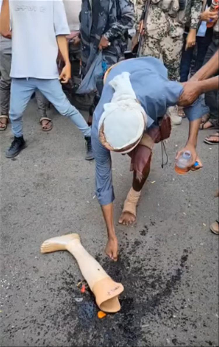 أحد جرحى الحرب في تعز يحرق طرفه الصناعي احتجاجًا على انقطاع المرتبات منذ 5 أشهر .. فيديو