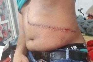 شاب يمني يضحي بنصف كبده لإنقاذ حياة غريب… ويُترك للمعاناة بعد ثلاث سنوات من الخيانة