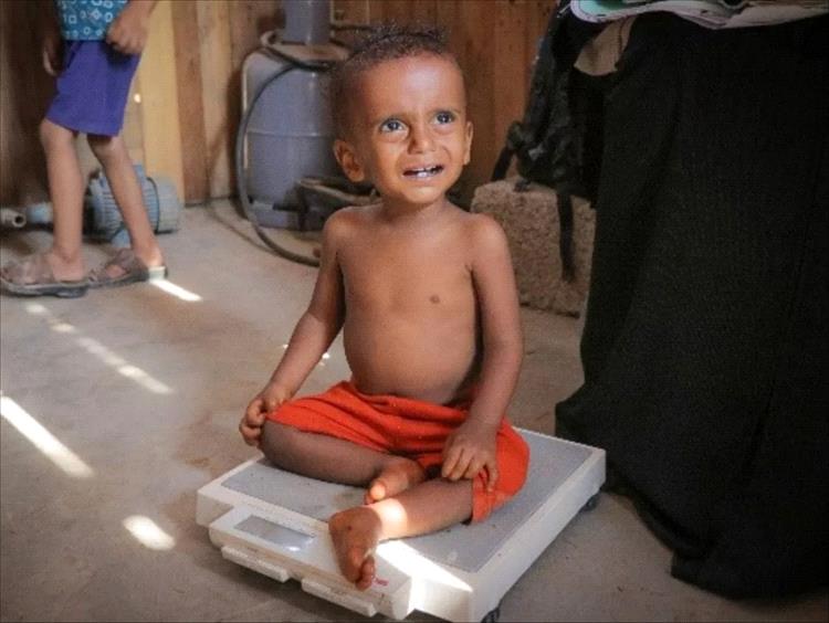 يونيسف تدعم علاج 166 ألف طفل يعانون من سوء التغذية الحاد الوخيم في مناطق خاضعة لسيطرة الحوثيين