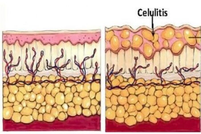 كل الحقائق عن السيلوليت: حلول وعلاجات وأخطاء شائعة