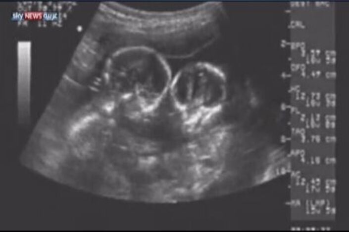 صوم الحامل (آمن) بعد الشهر الرابع