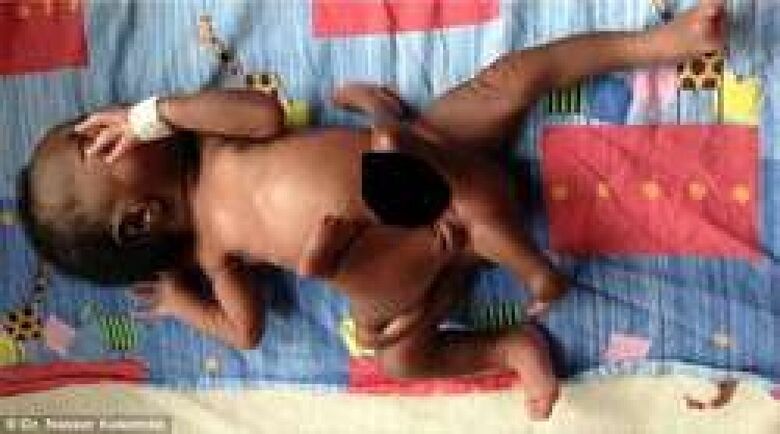 ولادة الطفل العنكبوت ، الحالة الأندر في التاريخ !