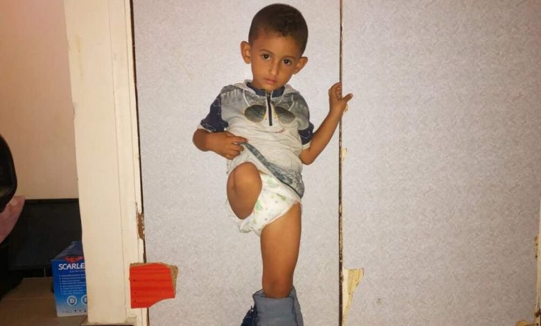 "منصور" الطفل العدني  الذي أحرمه الحوثيون من ساقه