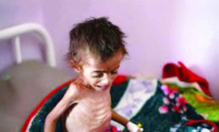 وفاة الطفلة أمل التي عرّت جرائم الحوثي